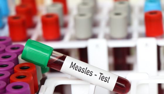 Health Officials Urging Families To Stay Vigilant Among Rise In
Measles Cases Across The Country