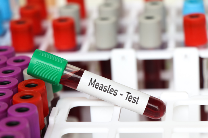 Measles test, blood sample to analyze in the laboratory